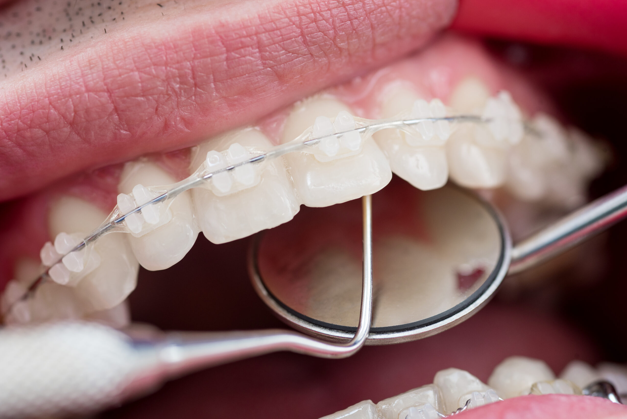 Keramikbrackets