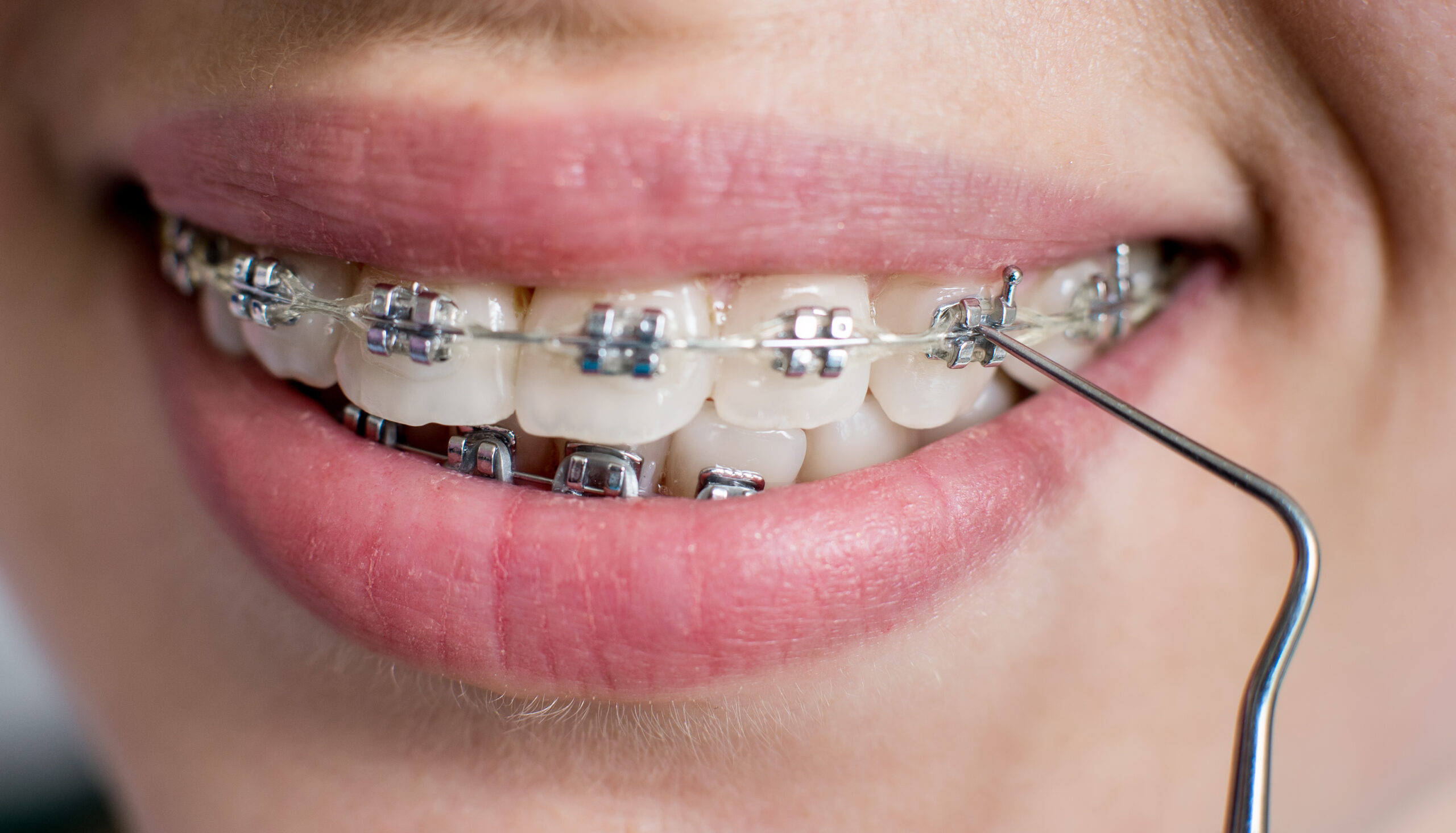 Metallbrackets