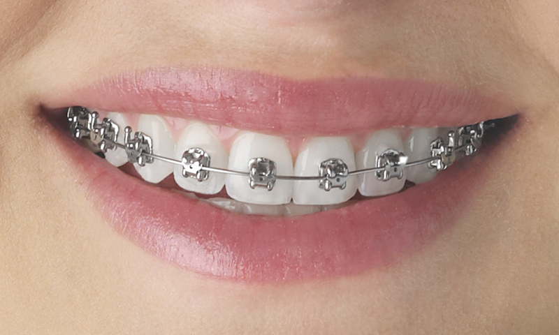 Selbstligierende Brackets