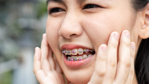 Zahnspange-Notfall: Draht piekst, Bracket abgefallen, Aligner gebrochen oder verloren – was tun?